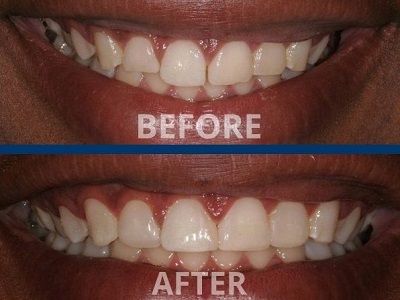 Diode Laser Gum Contouring After Braces
