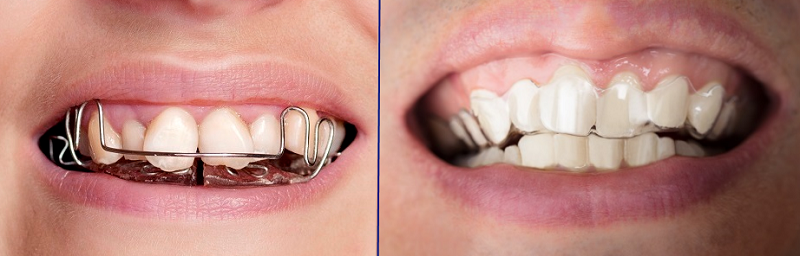Metal Braces vs. Invisalign - Bali Implant Aesthetic (BIA) Dental