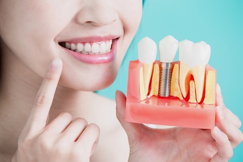 High-quality dental implants near Waunakee, WI