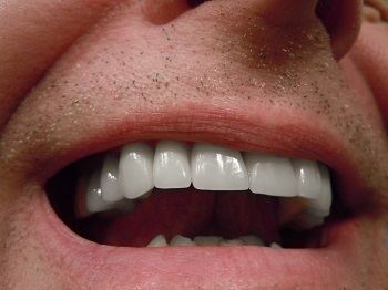 High-quality teeth whitening near Waunakee, WI