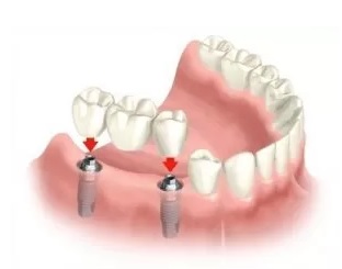 Dental Implants Redondo Beach - Torrance - Best South bay Dentist