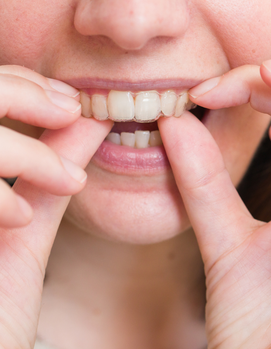 Invisalign clear braces assist in creating a straighter smile